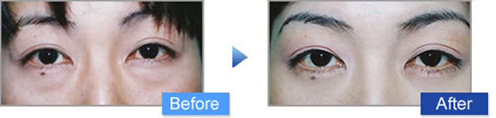 下眼瞼脱脂（下眼瞼のタルミ取り）施術例