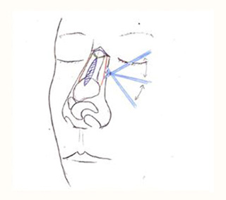 2.鼻骨の先端部分を、鼻の穴からノミを入れて削り、形を整えます。