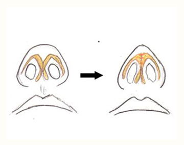 3.鼻筋をすっきり見せる為に、鼻翼の軟骨を上にずらすように縫いつけ、鼻の頭の位置を高くする（鼻尖拳上術）を行います。