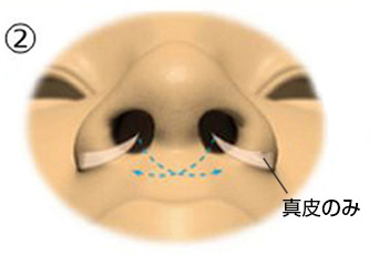 真ん中の皮下に両側を繋ぐ穴を開け、左右の真皮をそれぞれ穴に津通し、内側へ鼻翼を寄せ合う。